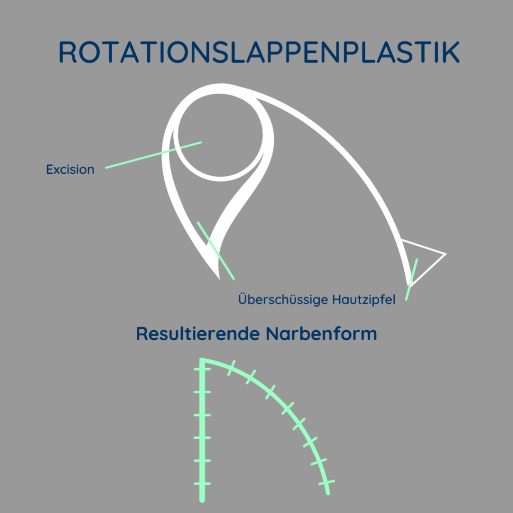 Abbildung zur schematischen Darstellung der Rotationslappenplastik.