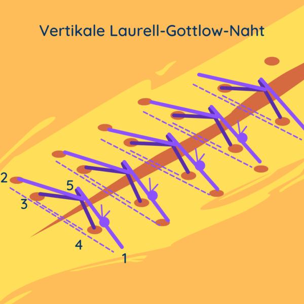 Nahttechniken - Versorgung dentalchirurgischer Wunden - Mednaht