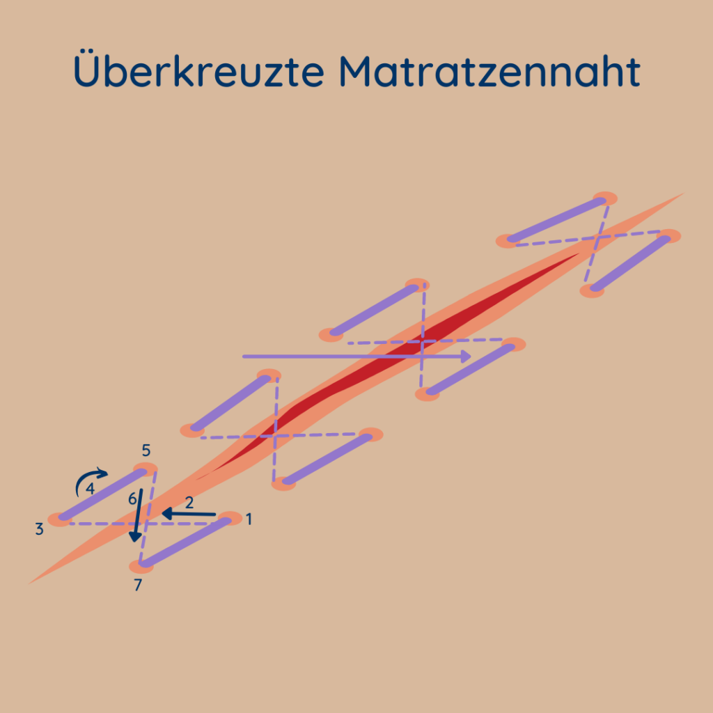 Nahttechniken: Abbildung multipler überkreuzter Matratzennähte samt Legende und Stichmuster.